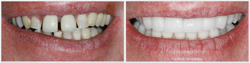 before and after Houston restorative dentistry