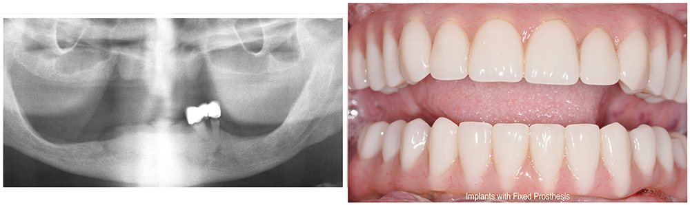before and after Houston dental implants