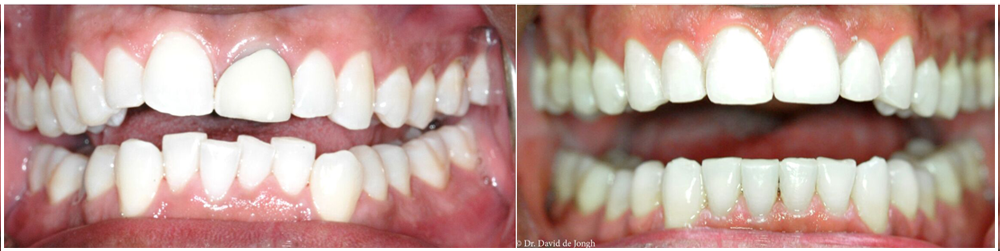 before and after Houston cosmetic dentistry