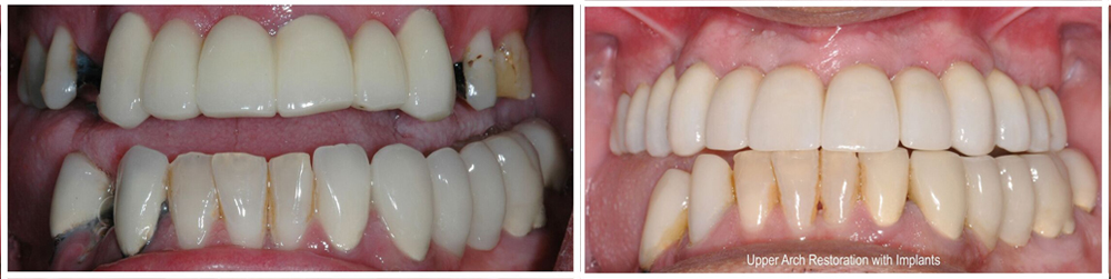 before and after Houston dental implants
