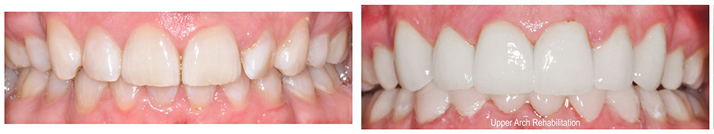 before and after Houston restorative dentistry