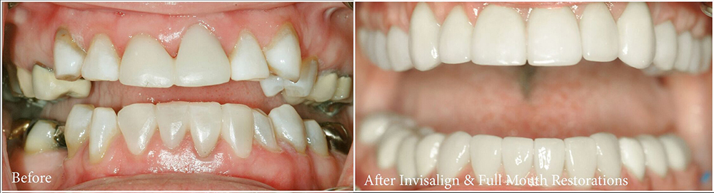 before and after Houston Invisalign