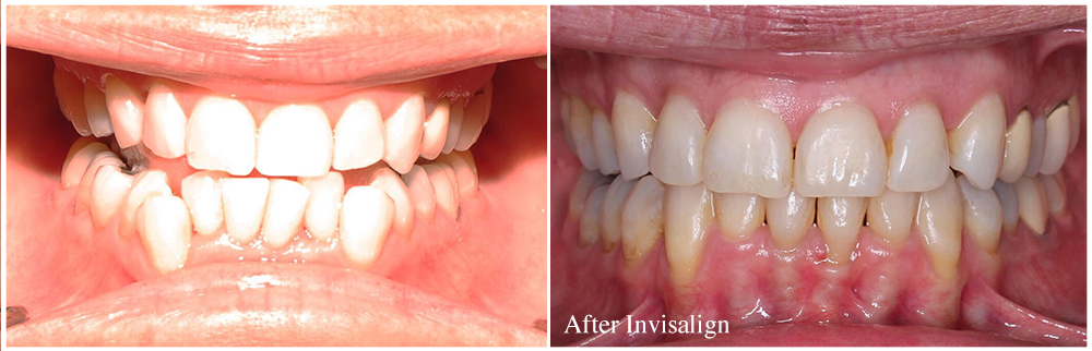 before and after Houston Invisalign