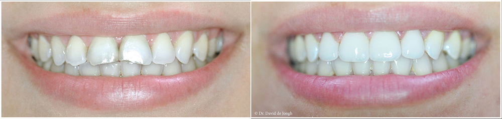 before and after Houston cosmetic dentistry
