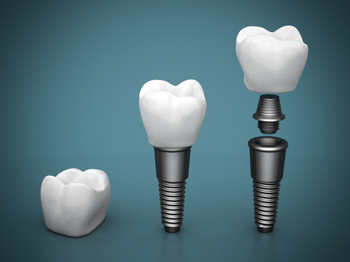 Dental implants on a blue background
