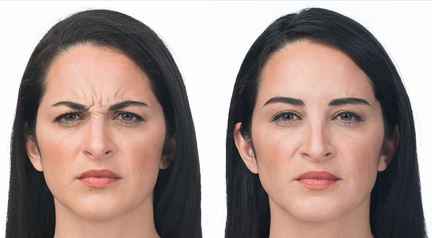 Houston botox before and after