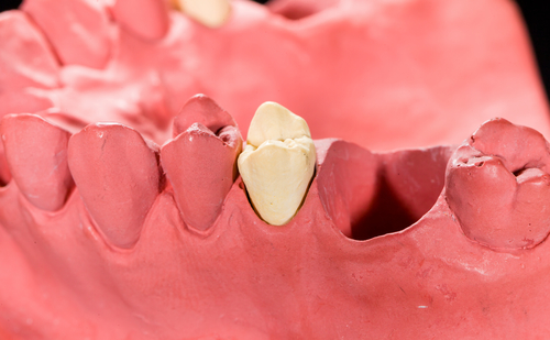 Closeup photo of red gypsum model with tooth loss