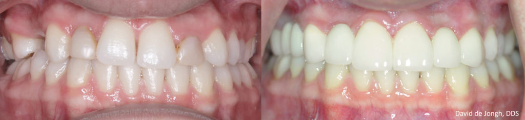 Houston porcelain crowns before and after