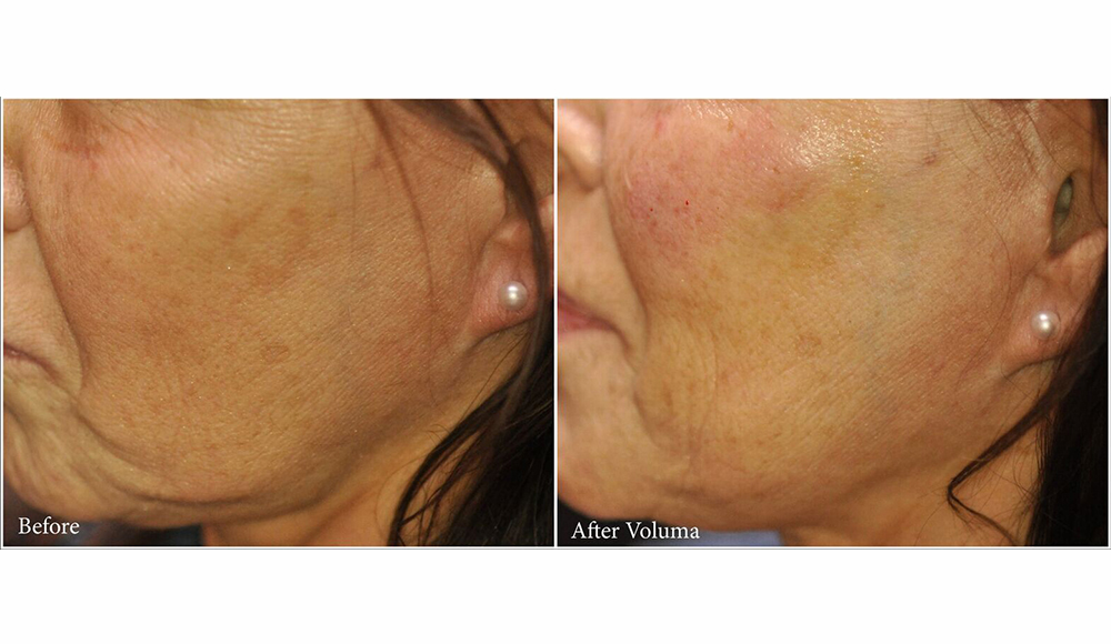 Houston voluma before and after