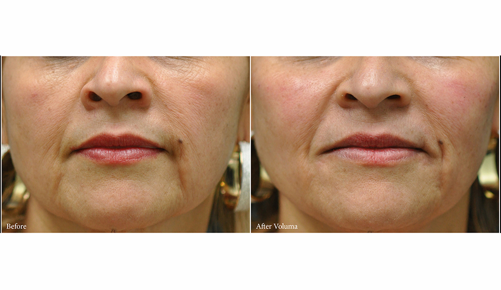 Houston voluma before and after