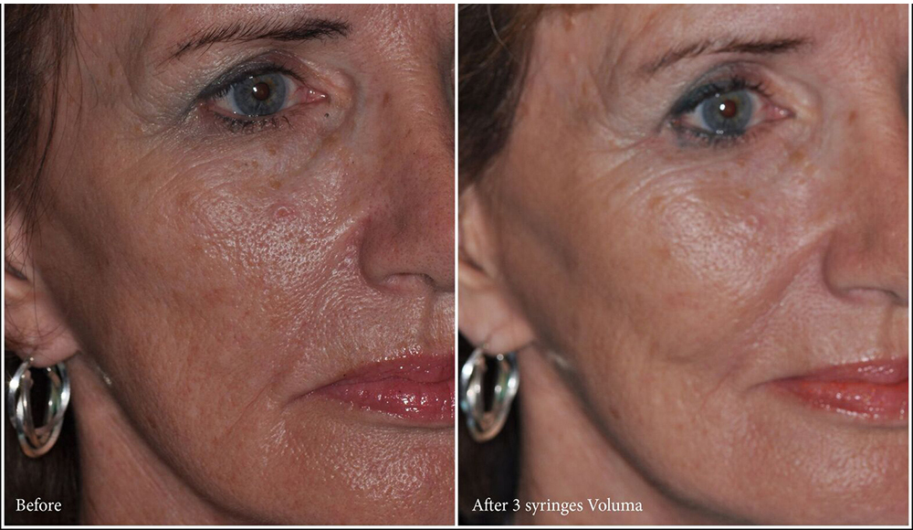 Houston voluma before and after